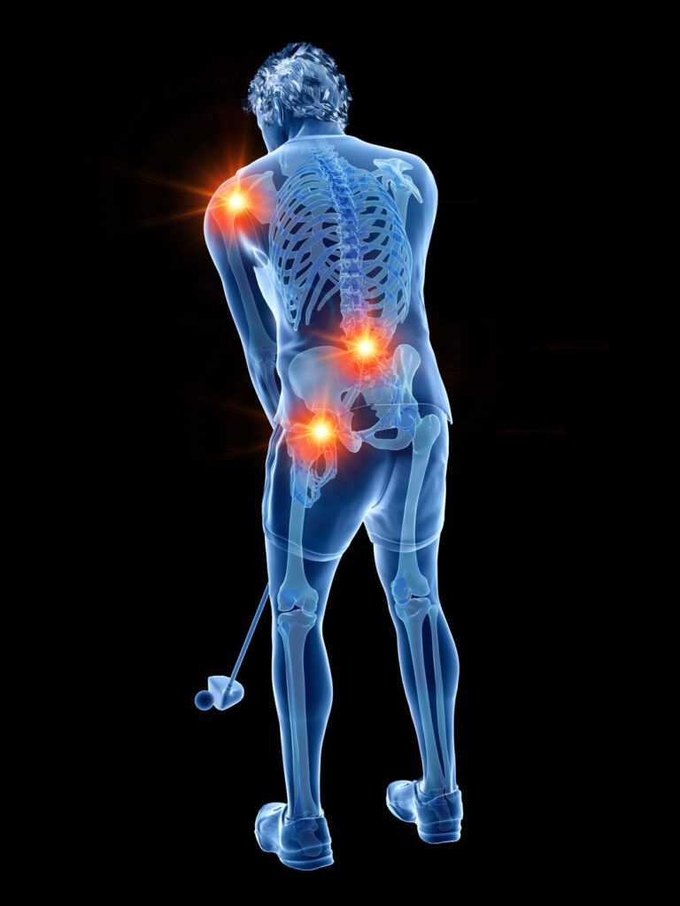 Golf injuries points shown on body diagram